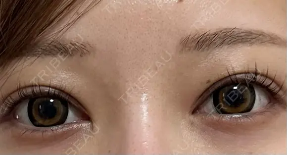 ヒアルロン酸注入（涙袋） / ヒアルロン酸注入（唇） EMMO FACE CLINIC 東京三田院 BEFORE メイン用