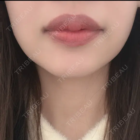 ヒアルロン酸注入（唇） TCB東京中央美容外科 青森院 BEFORE メイン用