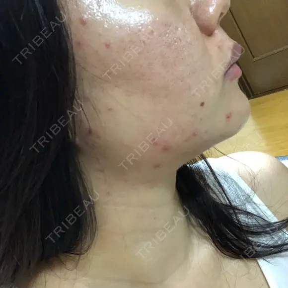 ニキビ治療 たにまちクリニック BEFORE メイン用