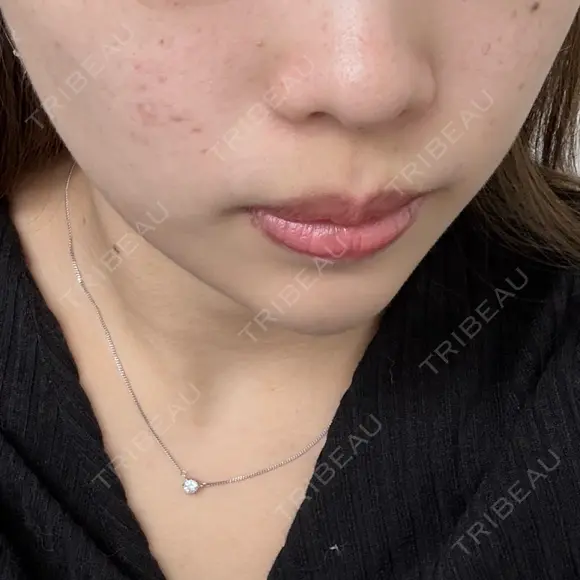 ボトックス（口角） / 毛穴洗浄（ハイドラフェイシャルなど） / ルメッカ 東京シルククリニック 東京神田院 BEFORE メイン用