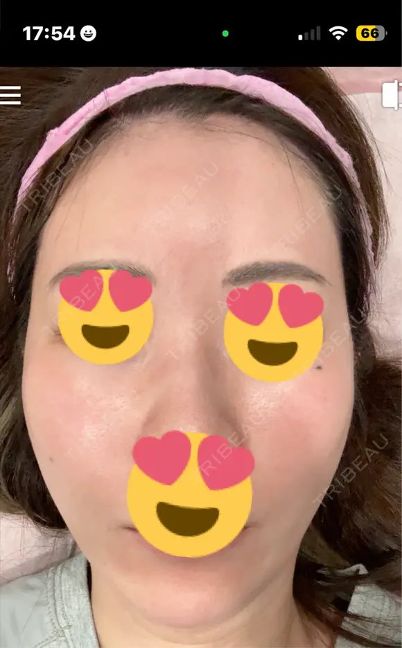 ピーリング（ハリ・ツヤ） / ピコスポット ビューティー和心クリニック 浅草院 BEFORE メイン用