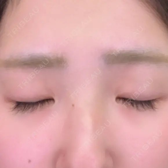 二重埋没 / その他（目元） 湘南美容クリニック 福島院 BEFORE メイン用