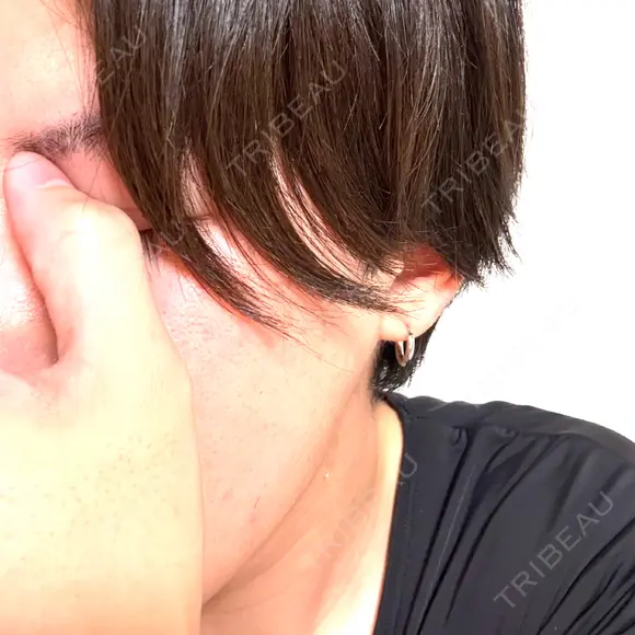 ほくろ・いぼ除去レーザー（肌） 共立美容外科 福岡院 BEFORE メイン用