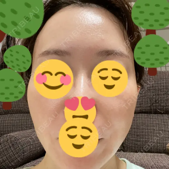 肌育注射（ジュベルックなど） / リジュラン 城本クリニック 大阪院 BEFORE メイン用