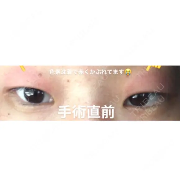 二重埋没 湘南美容クリニック 大阪堺東院 BEFORE メイン用