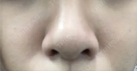 鼻尖形成（切開） / ヒアルロン酸注入（あご） TCB東京中央美容外科 世田谷院 BEFORE メイン用