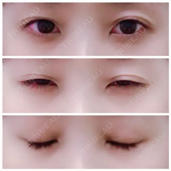 二重埋没 / 眼瞼下垂（切開） / クマ治療 / 下まぶたの脂肪取り THE MEDICAL SALON BEFORE メイン用