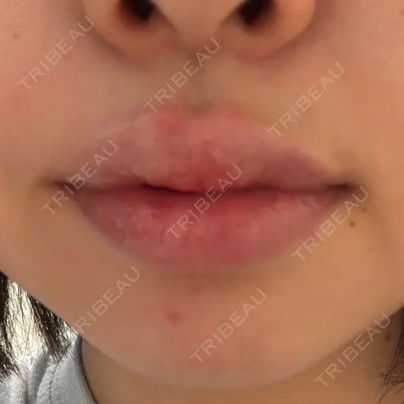 肌ヒアルロン酸注入（たるみ・シワ改善） / シワ取りボトックス / RF（高周波）たるみ治療 東京シルククリニック 東京神田院 BEFORE メイン用