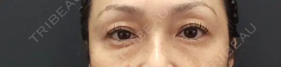 下まぶたたるみ取り 湘南美容クリニック 千葉センシティ院 BEFORE メイン用