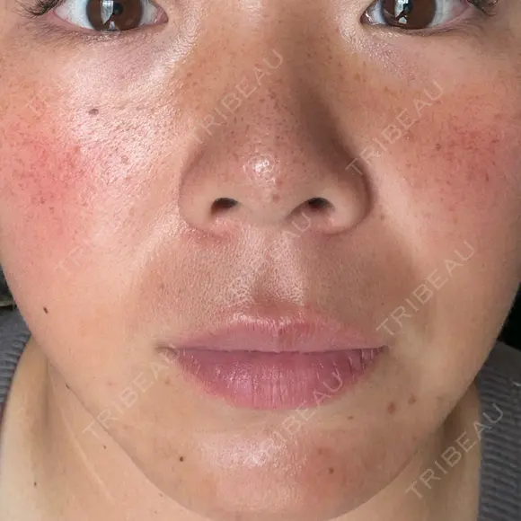 ルメッカ 大美会クリニック 京都烏丸院 BEFORE メイン用