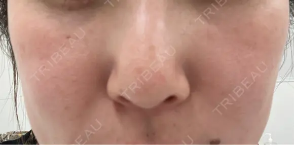 ルメッカ ルラ美容クリニック 札幌本院 BEFORE メイン用