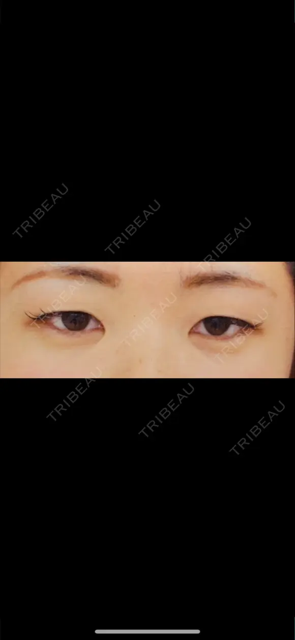 二重埋没 城本クリニック 姫路院 BEFORE メイン用