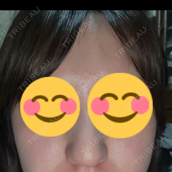 オンダリフト LIGHT CLINIC 【ライトクリニック】 名古屋院 BEFORE メイン用