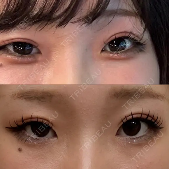 目頭切開 / 眼瞼下垂（切開） サラ美容外科 BEFORE メイン用