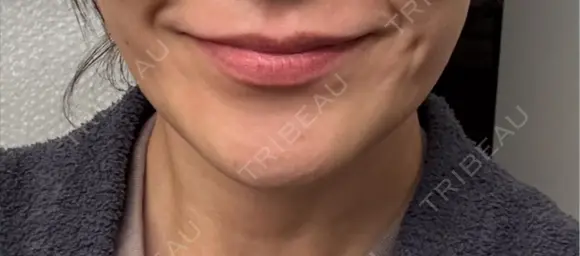 ボトックス（エラ・小顔） 札幌TAクリニック BEFORE メイン用