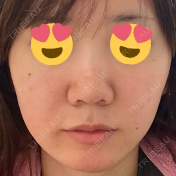 毛穴洗浄（ハイドラフェイシャルなど） DAILY SKIN CLINIC 心斎橋院 BEFORE メイン用