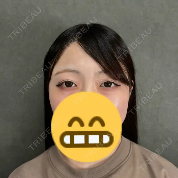 二重埋没 ネビュラクリニック 京都院 BEFORE メイン用