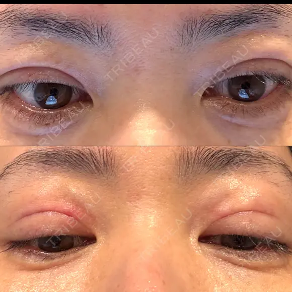 二重埋没 KIMI CLINIC 形成・美容外科 BEFORE メイン用