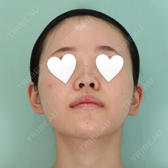 隆鼻術 / 軟骨移植 / 鼻尖形成（非切開） / 鼻中隔延長（非切開） WOM CLINIC GINZA （ワム クリニック ギンザ） BEFORE メイン用