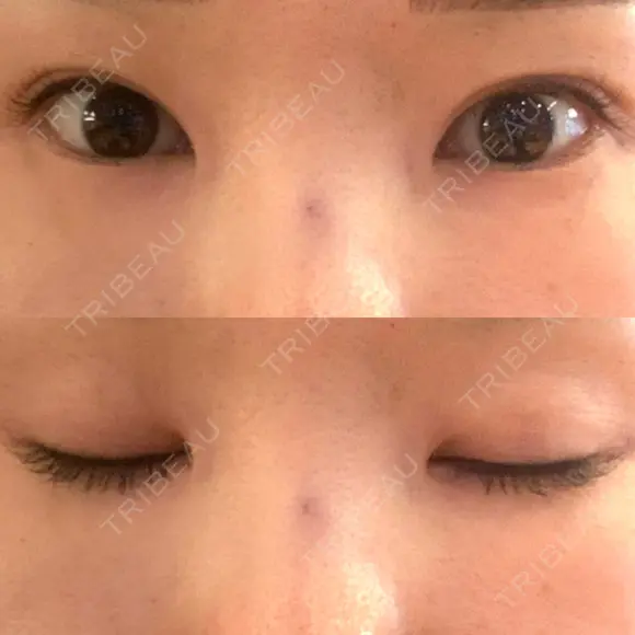 二重切開 / 目頭切開 / その他（目元） / 目尻切開 / タレ目形成・グラマラスライン（切開） id（アイディ）美容外科 BEFORE メイン用