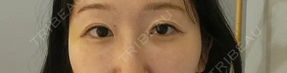 ヒアルロン酸溶解 小木曽クリニック BEFORE メイン用