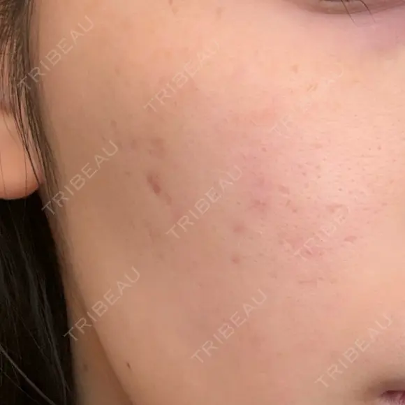 サブシジョン TRUE DESIGN CLINIC BEFORE メイン用