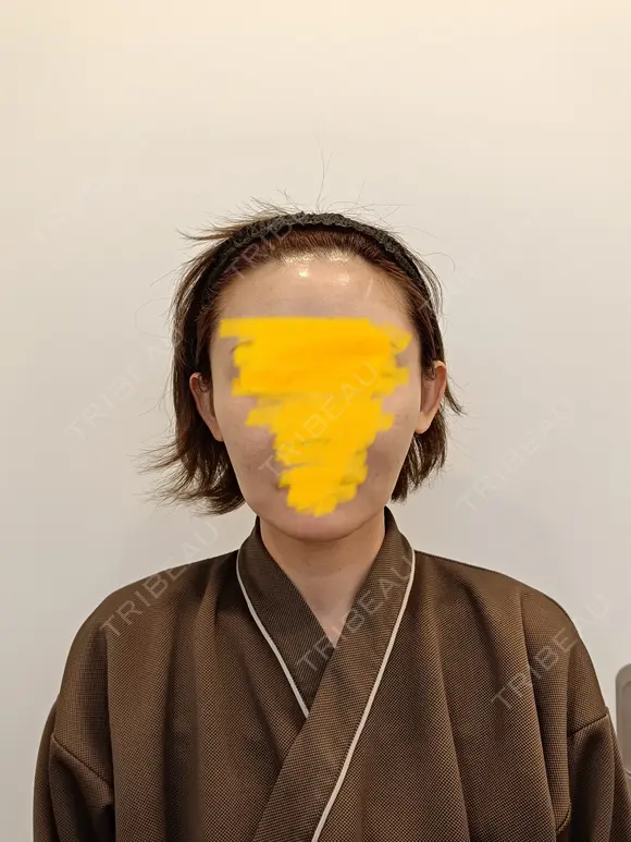 糸リフト / 脂肪吸引（顔） / ジョールファット除去 RIVER CLINIC（リバークリニック） BEFORE メイン用