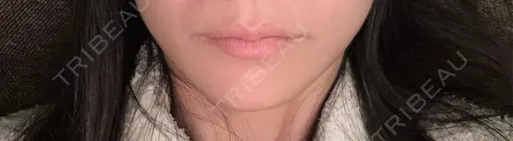 ボトックス（エラ・小顔） TCB東京中央美容外科 藤沢院 BEFORE メイン用