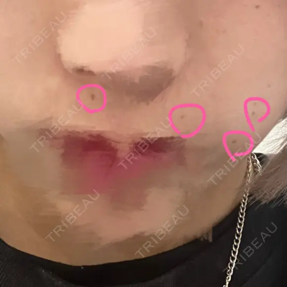 ほくろ・いぼ切除（肌） 心斎橋KT美容クリニック BEFORE メイン用