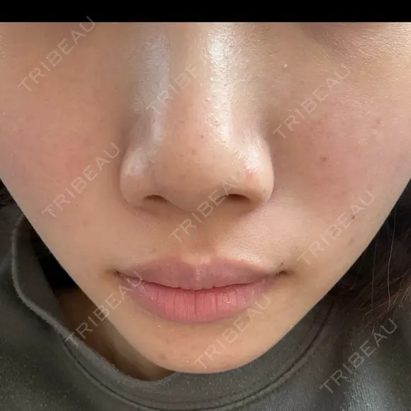 フォトRF 湘南美容クリニック 長野院 BEFORE メイン用