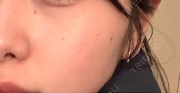 ほくろ・いぼ除去レーザー（肌） 心斎橋KT美容クリニック BEFORE メイン用