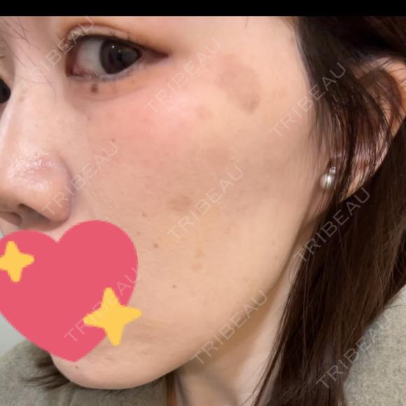 イオン導入 / ピーリング（ハリ・ツヤ） / ルメッカ ルラ美容クリニック 広島院 BEFORE メイン用