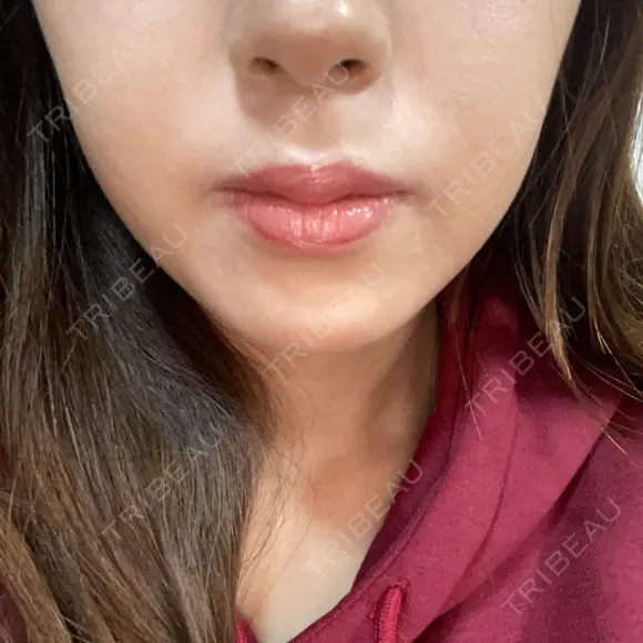 ハイフ（顔） 共立美容外科 大阪本院 BEFORE メイン用