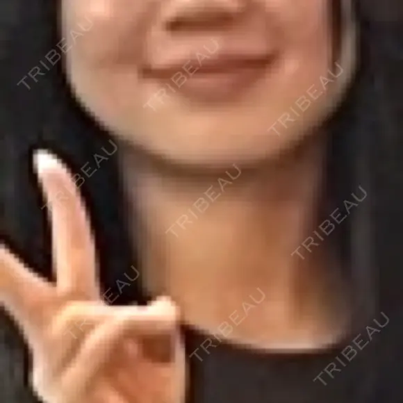 糸リフト / バッカルファット除去 / 脂肪吸引（顔） / メーラーファット除去 / ジョールファット除去 / 脂肪注入（輪郭） First Clinic BEFORE メイン用