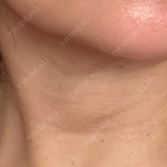 ヒアルロン酸注入（首） MKクリニック 銀座院 BEFORE メイン用