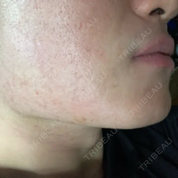 医療脱毛（顔） ZX-CLINIC 梅田院 BEFORE メイン用