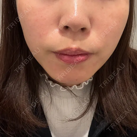 脂肪溶解注射（顔） BAO CLINIC 神戸院 BEFORE メイン用