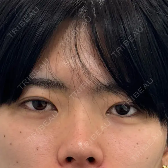 ヒアルロン酸注入（涙袋） / ボトックス（エラ・小顔） 新未来クリニック BEFORE メイン用