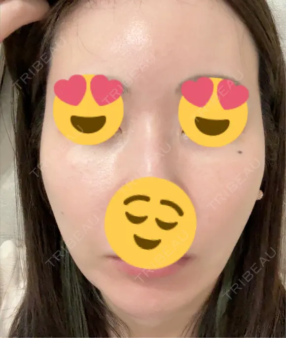 フラクショナルレーザー（毛穴・ニキビ跡） おおかみ美容のクリニック 新宿院 BEFORE メイン用