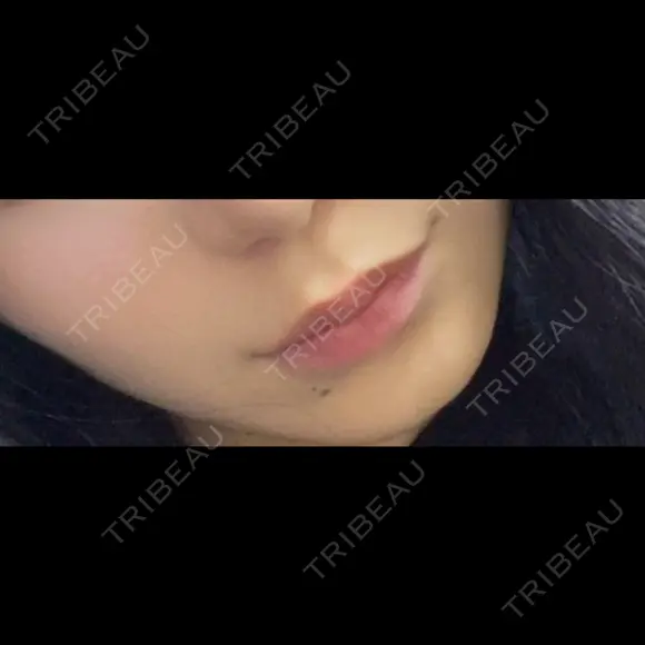 シワ取りボトックス 東京シルククリニック 新宿院 BEFORE メイン用