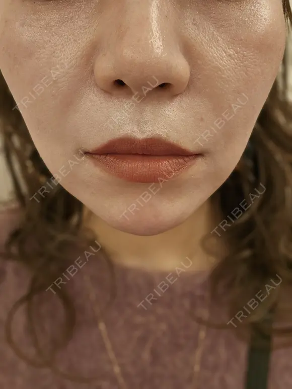 その他 MKクリニック 日本橋院 BEFORE メイン用