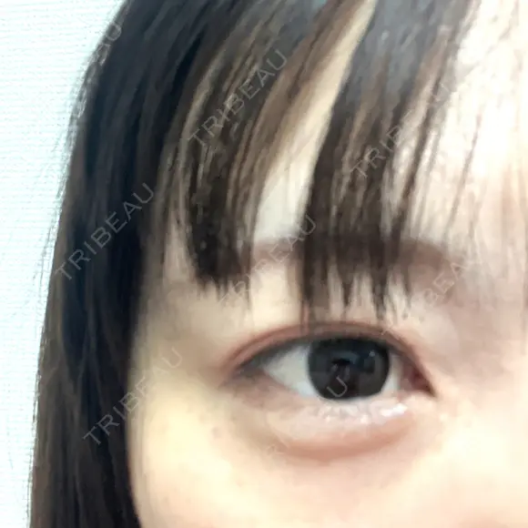 人中短縮 / 小鼻縮小（非切開） / ヒアルロン酸注入（涙袋） / ヒアルロン酸注入（唇） / ヒアルロン酸注入（目の下） / ボトックス（人中） Evergreen medical clinic BEFORE メイン用