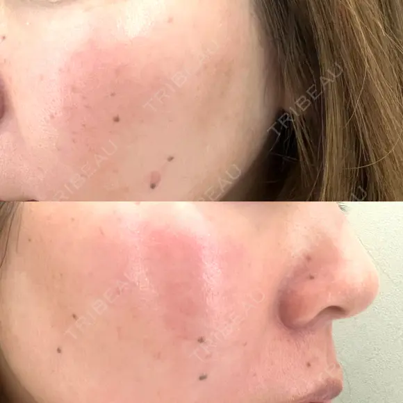 ルメッカ J CLINIC BEFORE メイン用