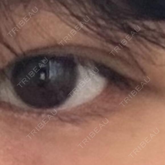 ヒアルロン酸注入（涙袋） Evergreen medical clinic BEFORE メイン用