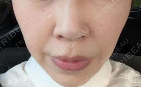 ヒアルロン酸注入（頬） ルラ美容クリニック 岡山院 BEFORE メイン用
