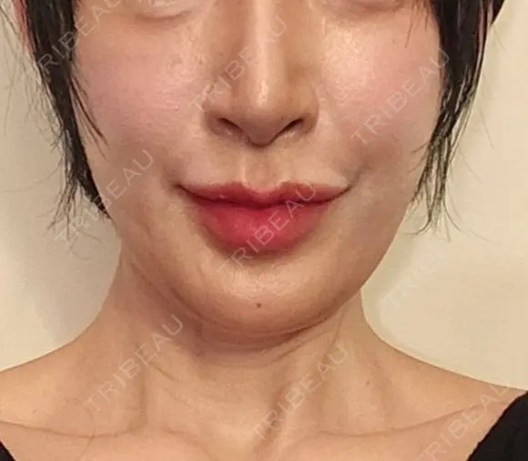 糸リフト 形成外科と美容外科のクリニック池袋 BEFORE メイン用