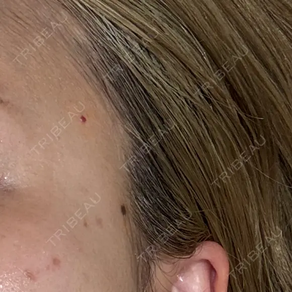 ほくろ・いぼ除去レーザー（肌） Fellez Clinic【フェルズクリニック】 BEFORE メイン用