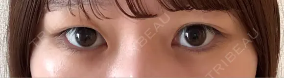 二重埋没 / 上まぶたの脂肪取り EMMA CLINIC（エマクリニック） BEFORE メイン用