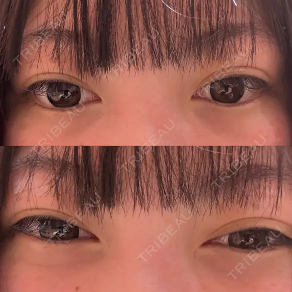 ヒアルロン酸注入（涙袋） / ヒアルロン酸注入（唇） HAAB BEAUTY CLINIC 南青山本院（新院） BEFORE メイン用