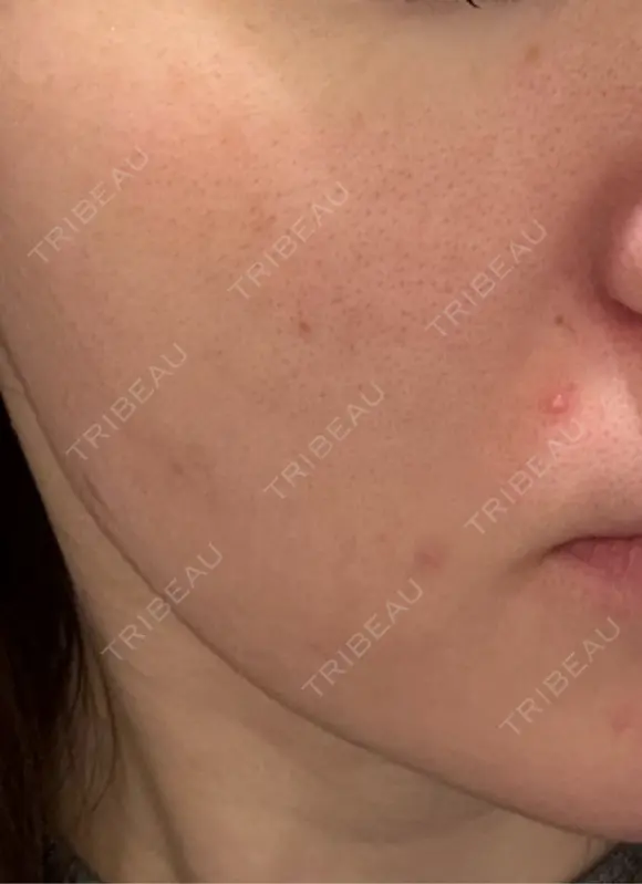 エレクトロポレーション / 毛穴洗浄（ハイドラフェイシャルなど） / ニードルRF（ポテンツァなど） クレオビューティークリニック BEFORE メイン用